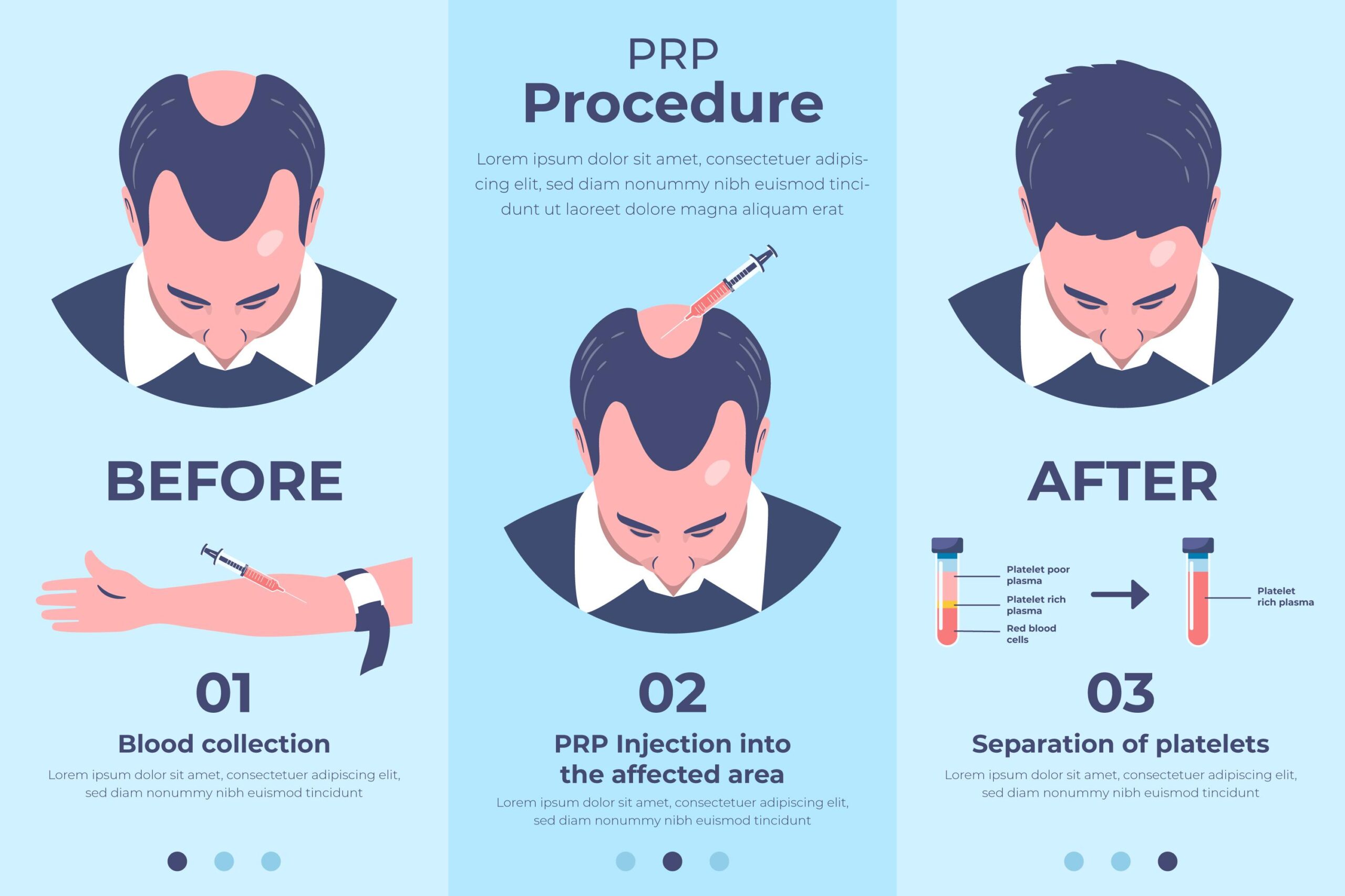 prp-procedure